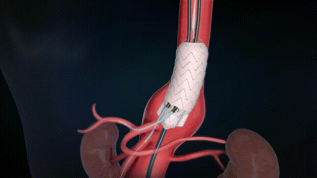 G-Branch 分支重建+髂内释放(深色无字幕20s)2024.10.11 00_00_00-00_00_30.gif G-Branch 分支重建+髂内释放(深色无字幕20s)2024.10.11 00_00_00-00_00_30.gif